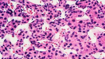 Researchers in the Department of Electrical and Computer Engineering are developing a new technique to better understand the composition of a cancerous tumor.