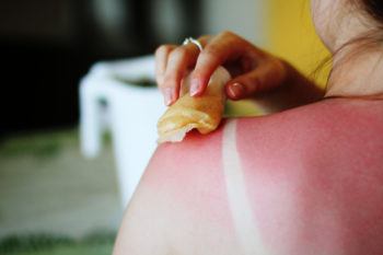 sunburn