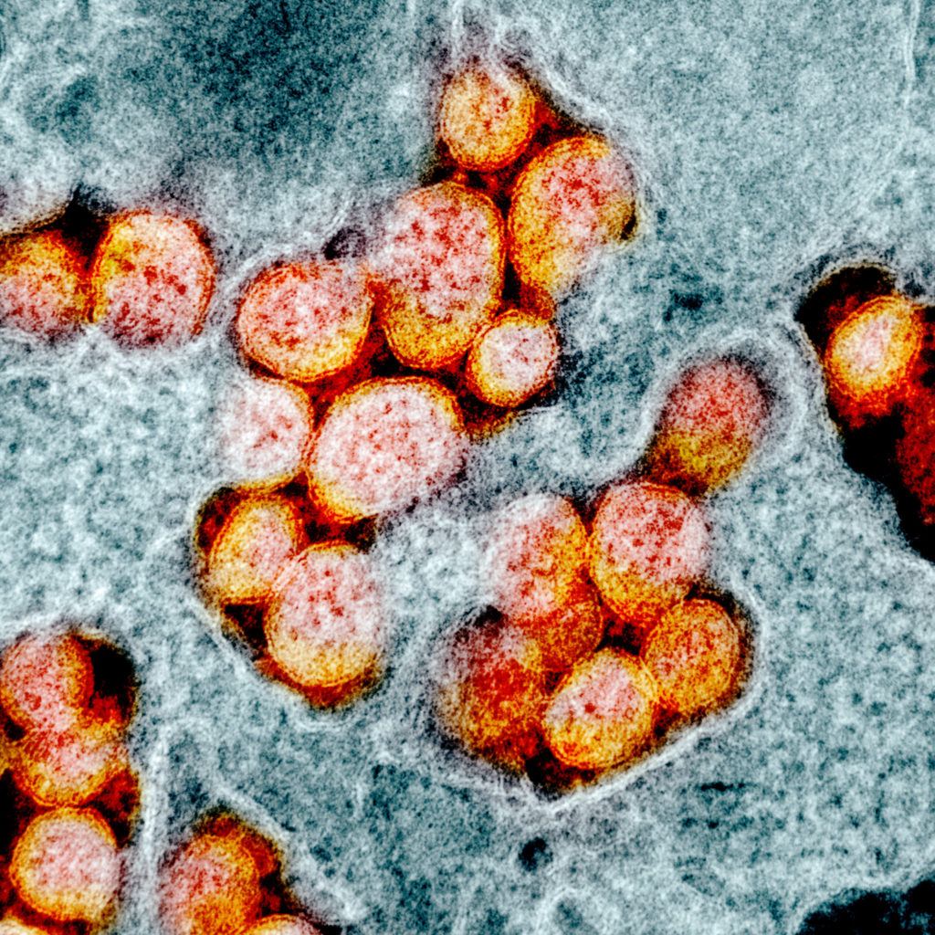 Transmission electron micrograph of SARS-CoV-2 virus particles, isolated from a patient.