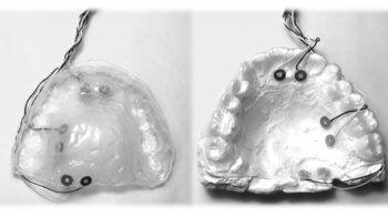 side by side view of top and bottom retainer models