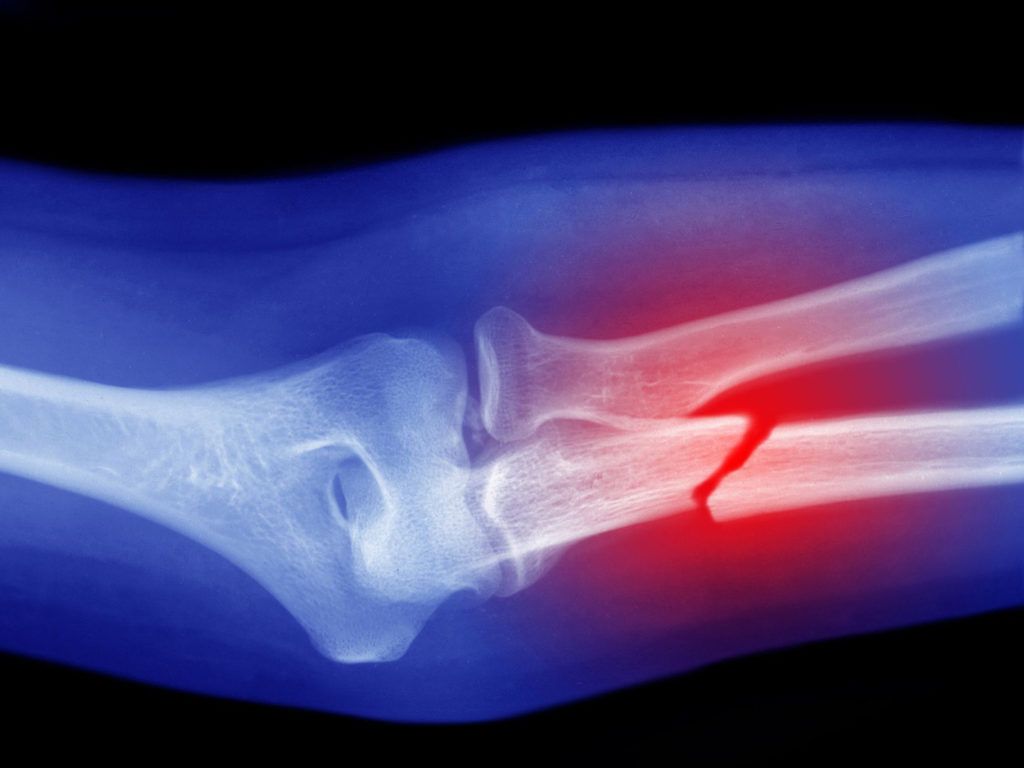 x-ray image of a broken arm