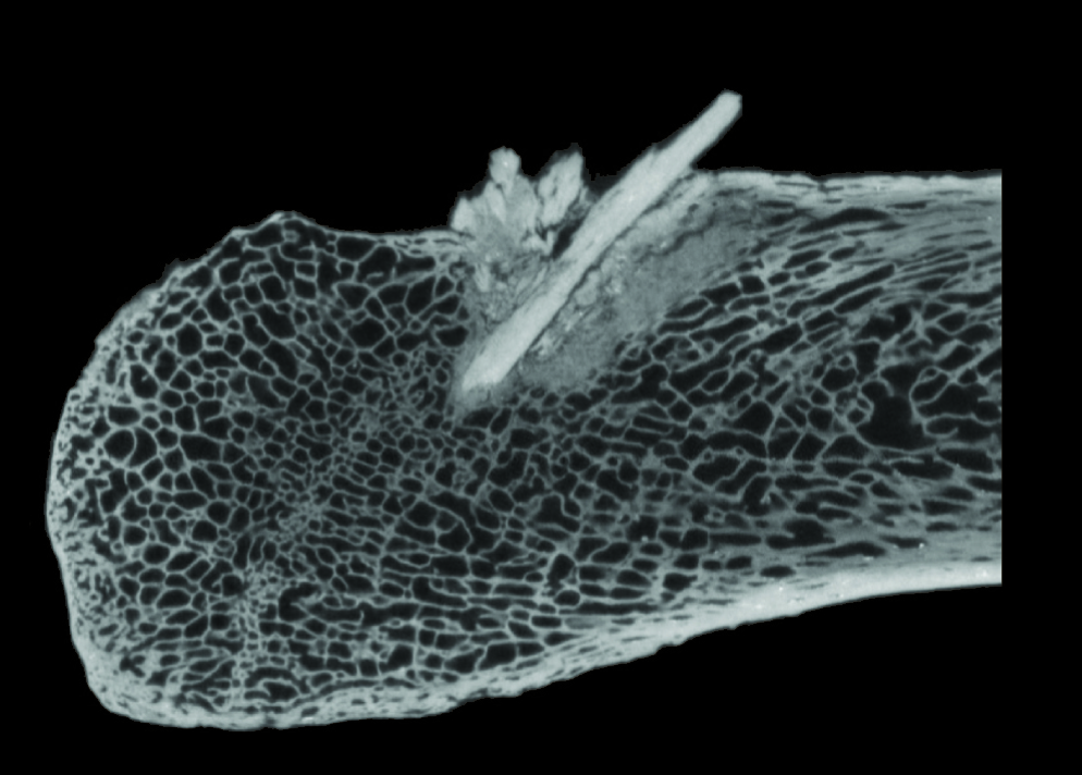 CT scan of bone point fragments embedded in the rib