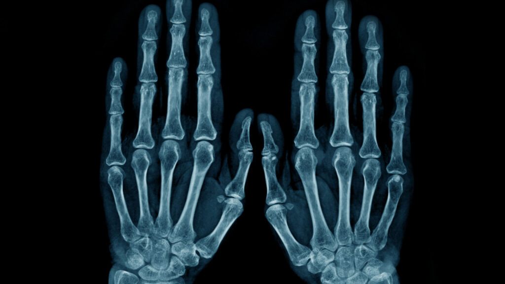 a photo of an X-ray of a pair of hands.