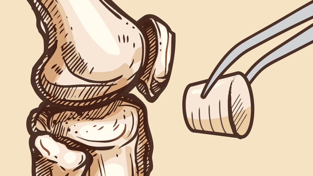 A rendering of a synthetic cartilage-capped regenerative osteochondral plug being implanted into a knee.