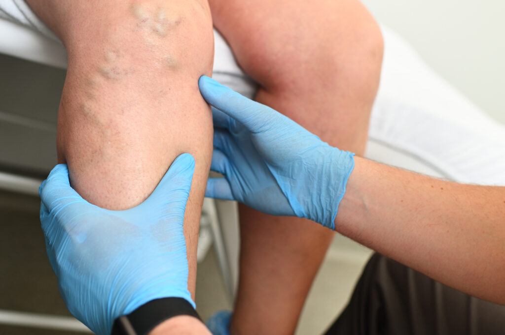 a phlebologist examines a patient with varicose veins on his leg. phlebology - study of venous pathologies of the lower extremities