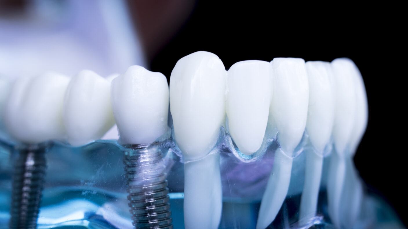 A close-up of dentures