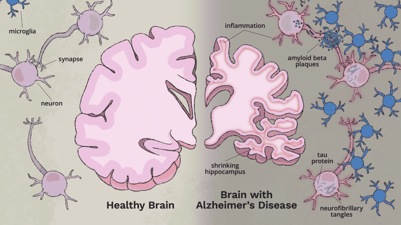 Technical illustration showing the difference in inflammation in a brain with Alzheimer's Disease versus a healthy brain