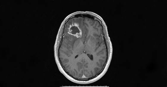 Scan of a glioblastoma tumor. (Credit: Gerard Toussaint, Texas A&M Health Science Center.)