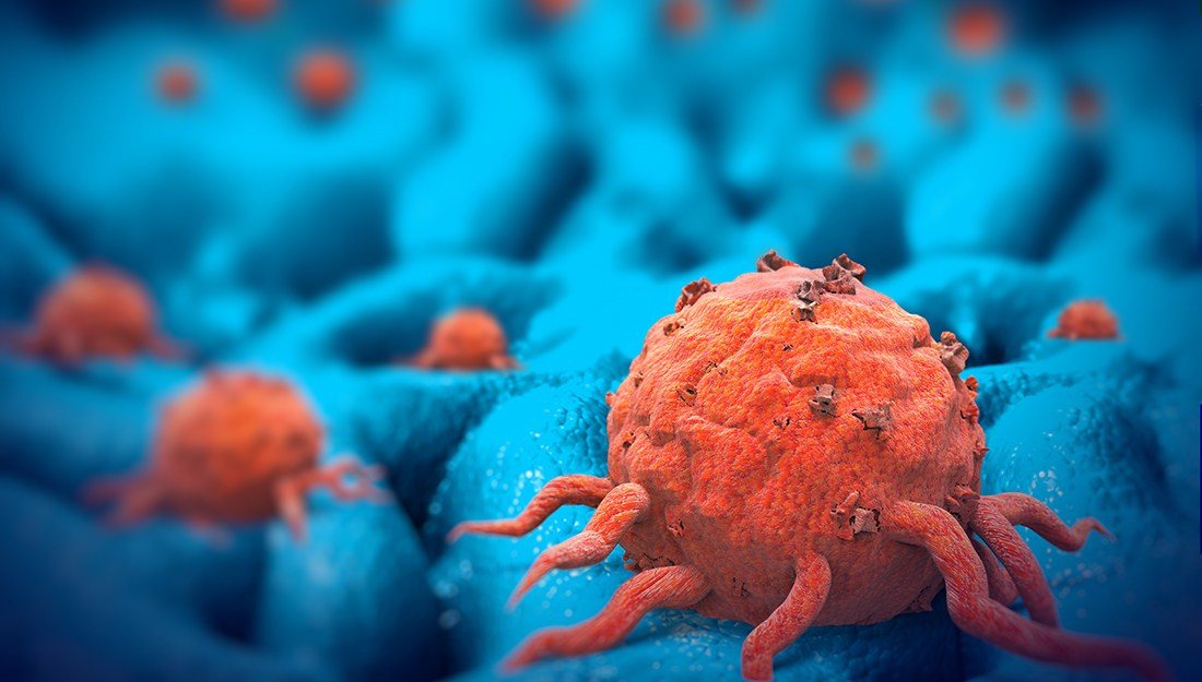 An enzyme overexpressed in cancer can be both a marker of the disease and a way to target the cancerous tumor